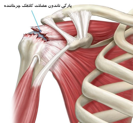 پارگی کلاهک چرخاننده