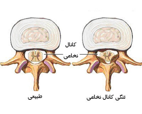 تنگی کانال نخاعی