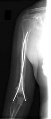 متاستاز استخوانی پایین بازو (نزدیک آرنج)