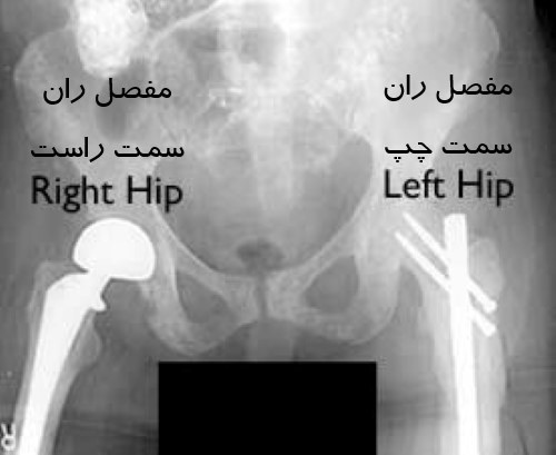 متاستاز استخوانی پایین تر از استخوان ران (سابتروکانتریک)