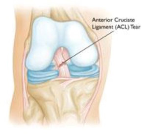 آسیب­ های رباط صلیبی قدامی (ACL)