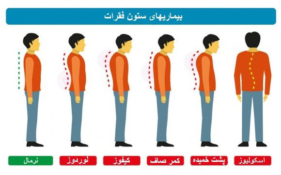بیماری های ستون فقرات