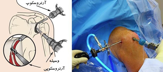 آرتروسکوپی شانه چیست