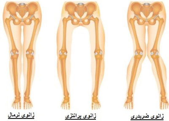 استئوتومی برای آرتروز زانو