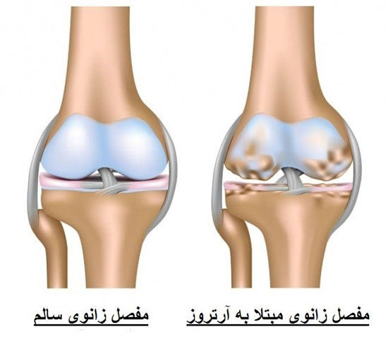 آرتروز زانو چیست