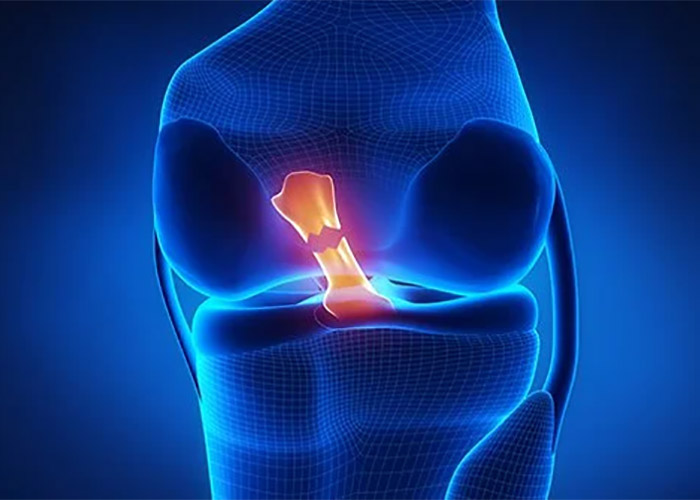 پارگی رباط صلیبی قدامی (ACL)