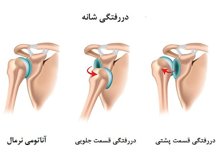 دررفتگی مکرر شانه