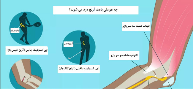 علل درد آرنج