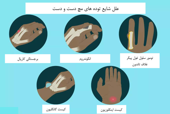 توده های رایج بر روی دست یا مچ دست