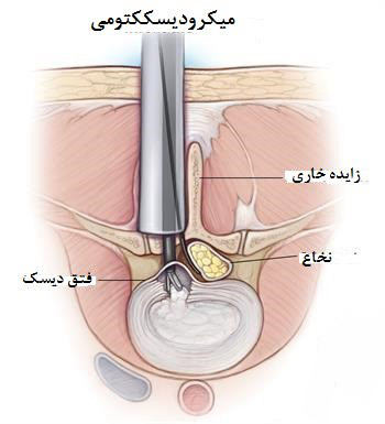 میکرودیسککتومی برای درمان درد سیاتیک