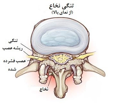 تنگی کانال نخاعی علت درد سیاتیک