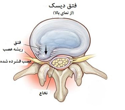 فتق دیسک (دیسک بیرون زده)