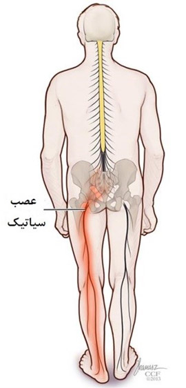 درد سیاتیک چیست