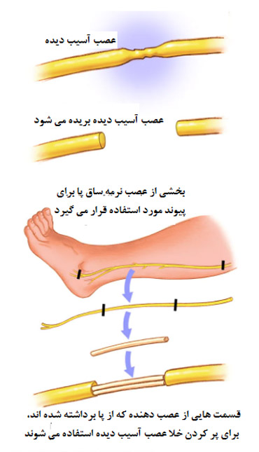 آسیب های اعصاب محیطی دست