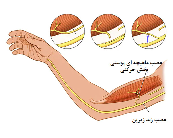 آسیب های اعصاب محیطی دست