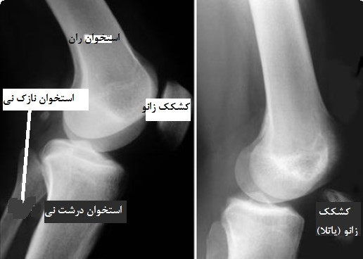 تصویربرداری پارگی تاندون چهار سر ران