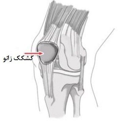 علل زانوی ناپایدار