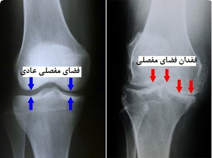 عکسبرداری کیست بیکر