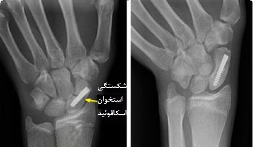 شکستگی استخوان اسکافوئید مچ دست