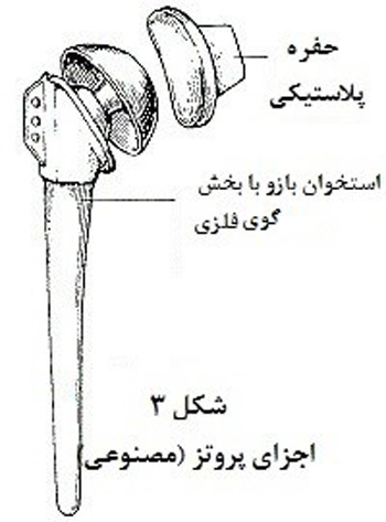 تعویض مفصل شانه
