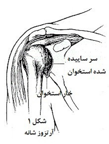 تعویض مفصل شانه