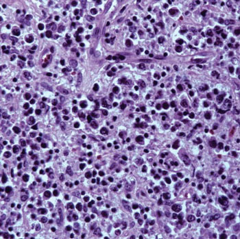 Lymphoma