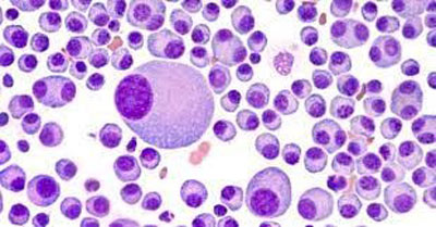 MULTIPLE MYELOMA
