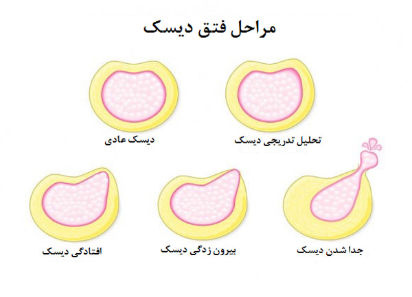 مراحل فتق دیسک گردن