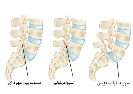 سرخوردگی مهره کمر