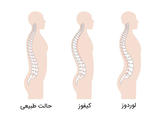 تفاوت لوردوز و کیفوز