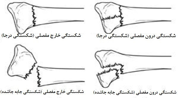 شکستگی مچ دست یا شکستگی دیستال رادیوس