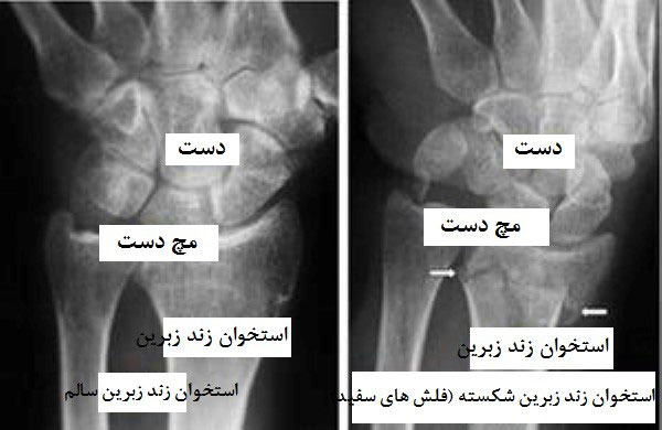 شکستگی مچ دست یا شکستگی دیستال رادیوس