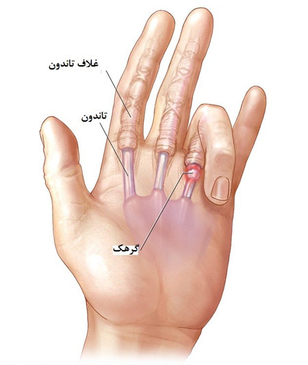 انگشت ماشه ای