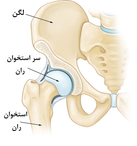 مرگ استخوان مفصل ران