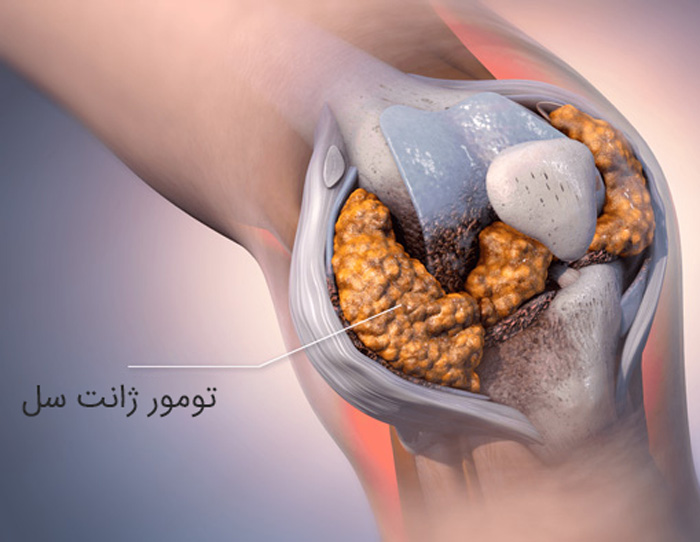 تومور ژانت سل استخوان