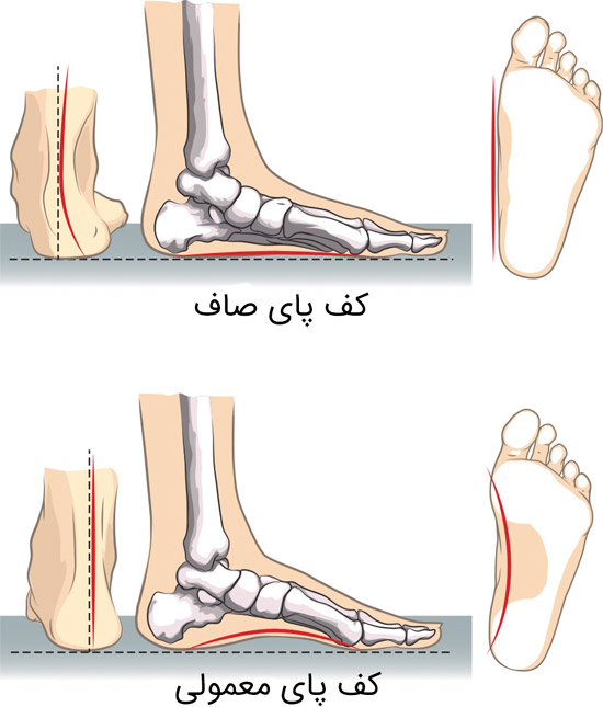 صافی کف پا چیست